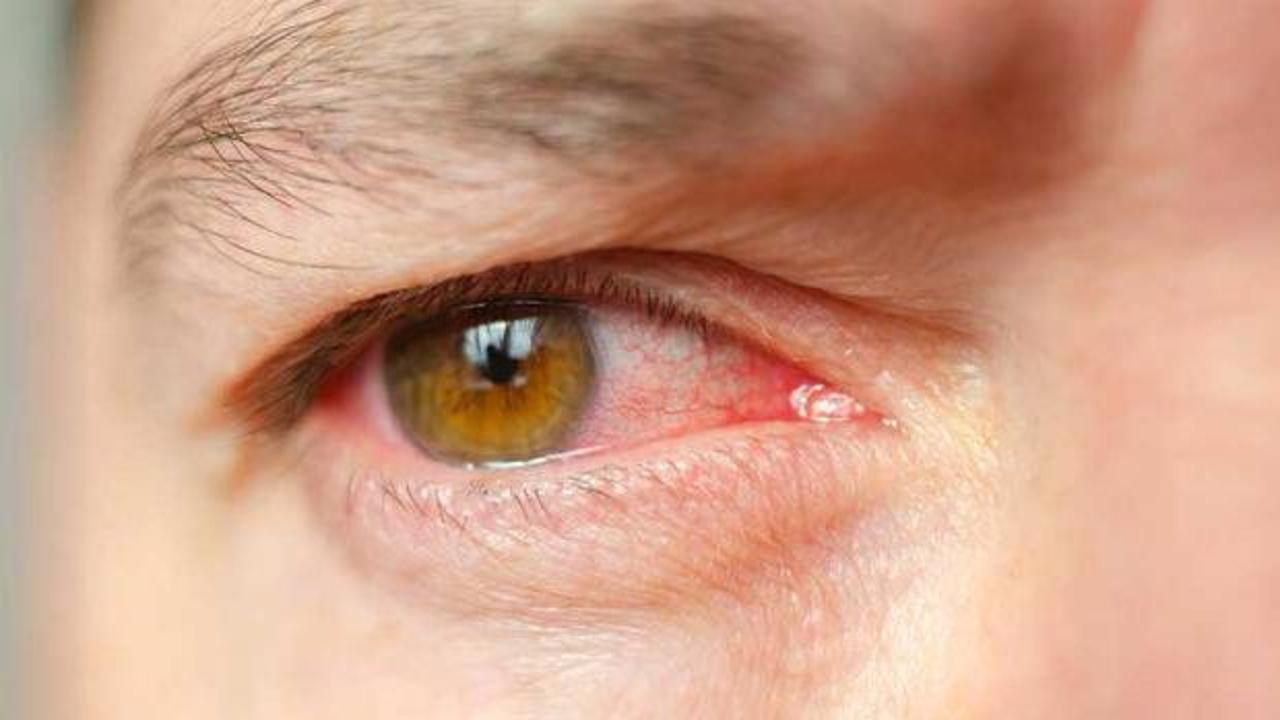 Türkiye’de 2 milyon kişi risk altında! Sessiz ilerliyor, kalıcı körlüğe neden olabiliyor